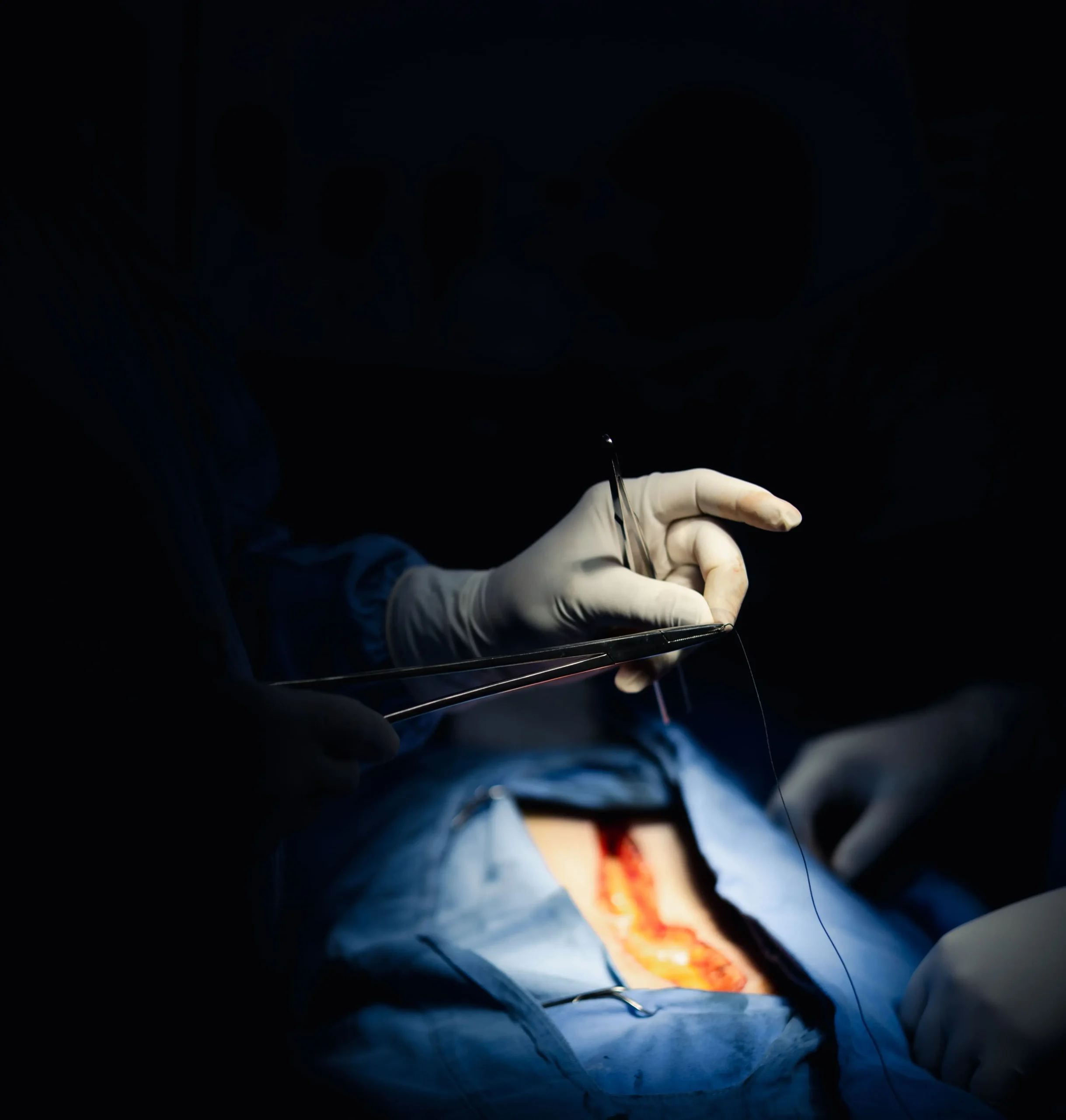 Laparotomía exploradora ca de colon izquierdo Cirugía de Traumatología