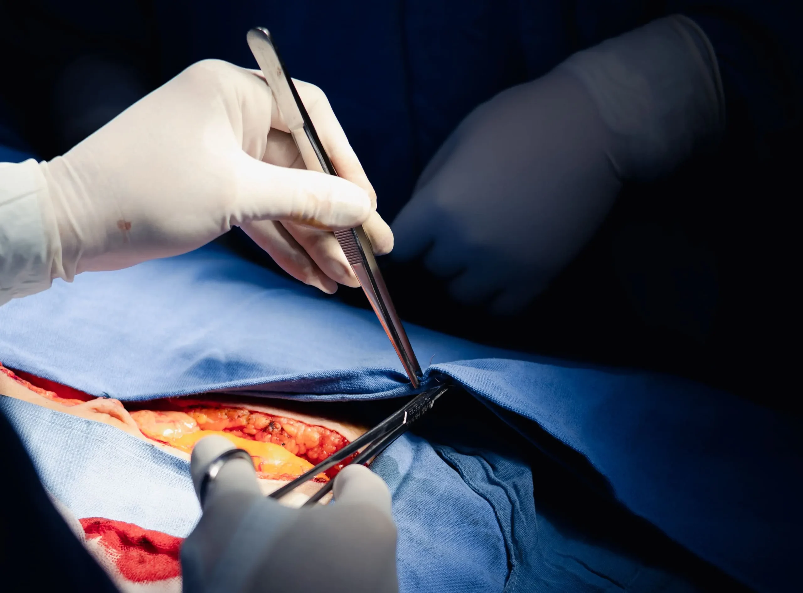 Laparotomía exploradora ca de colon izquierdo Tiroidectomía total