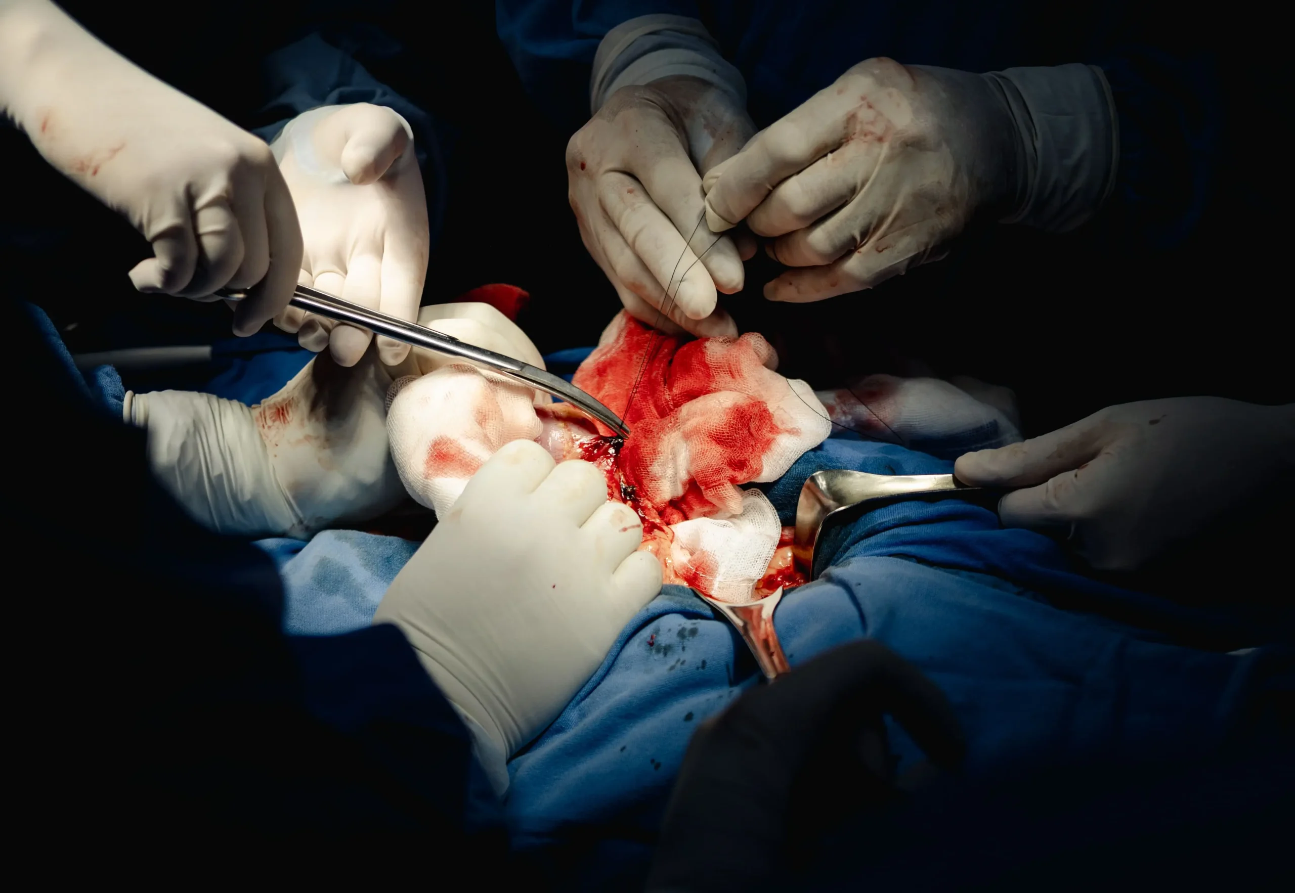 Laparotomía exploradora ca de colon izquierdo Dr. Sebastián González