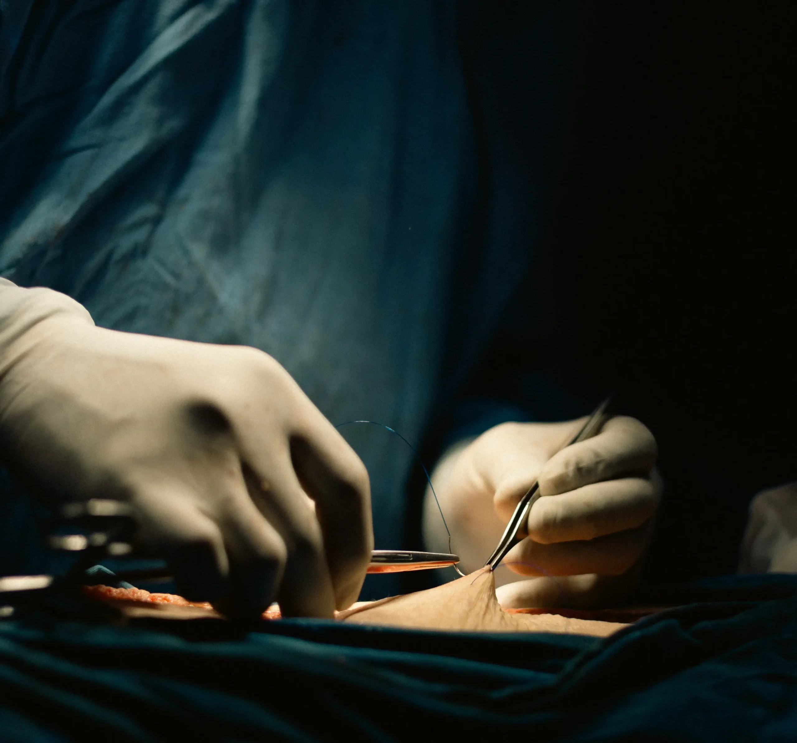 Laparotomía exploradora ca de colon izquierdo Cirugía de Traumatología