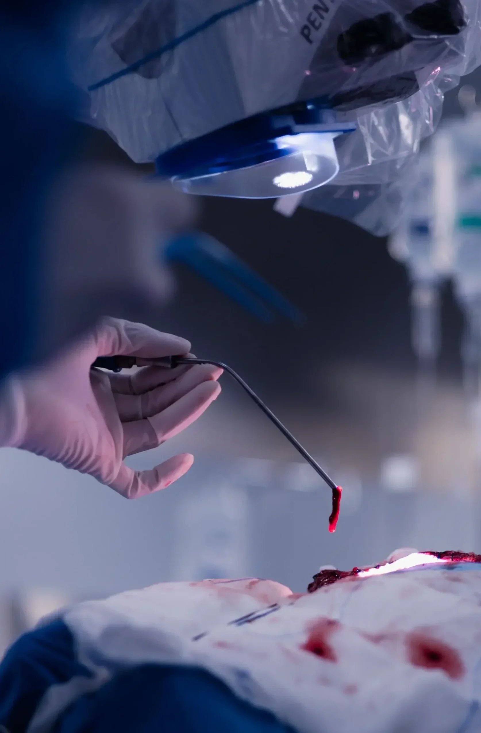 Resección de tumor en ala de esfenoides izquierdo probable meningioma.