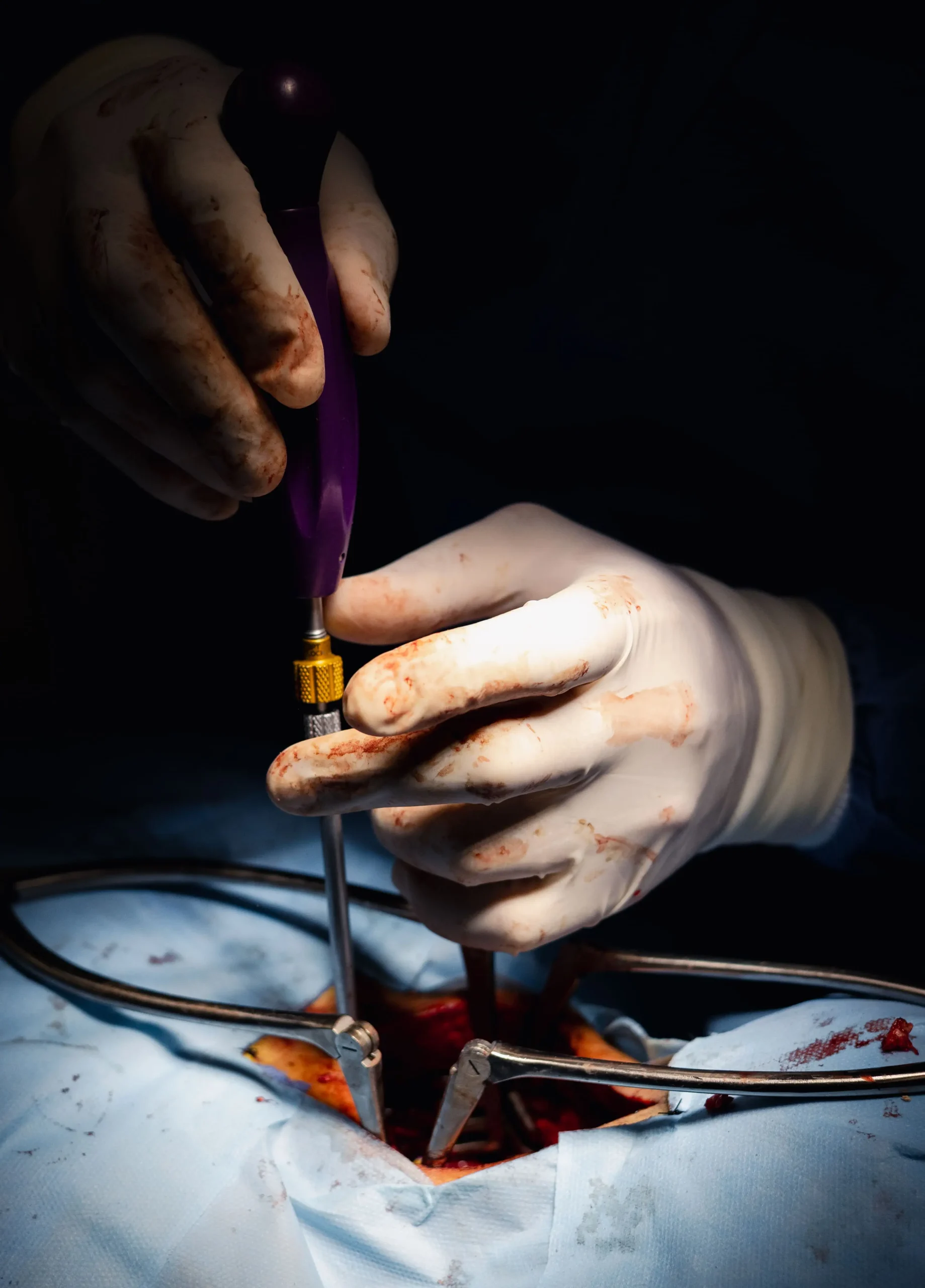 Resección de tumor en ala de esfenoides izquierdo probable meningioma.