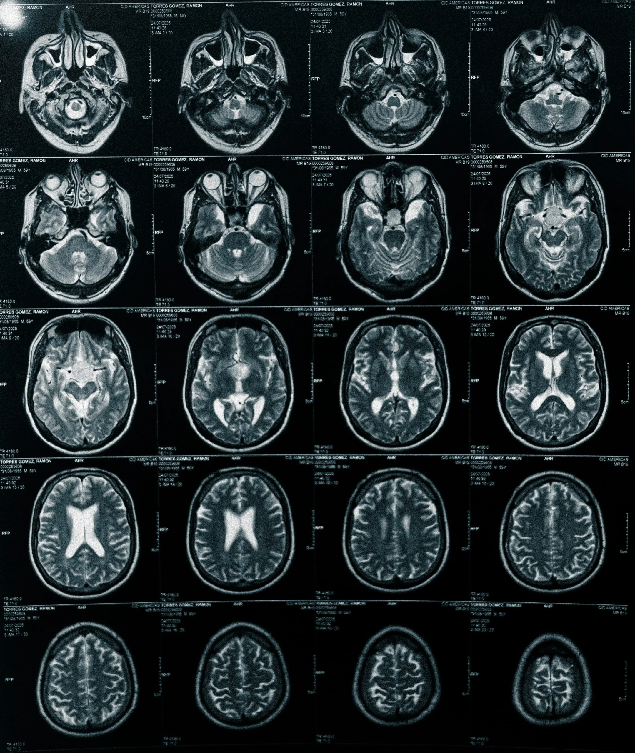 Resección transesfenoidal de tumor hipofisario Dr. Sebastián González