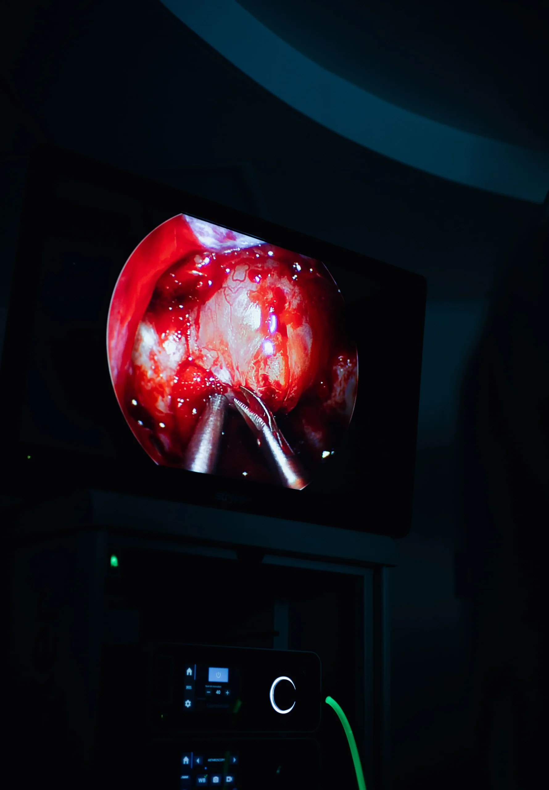Resección transesfenoidal de tumor hipofisario Tiroidectomía total