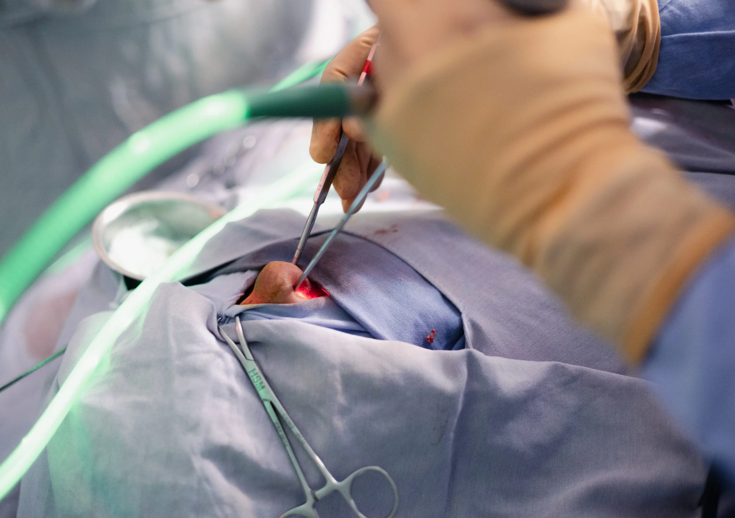 Resección transesfenoidal de tumor hipofisario Tiroidectomía total